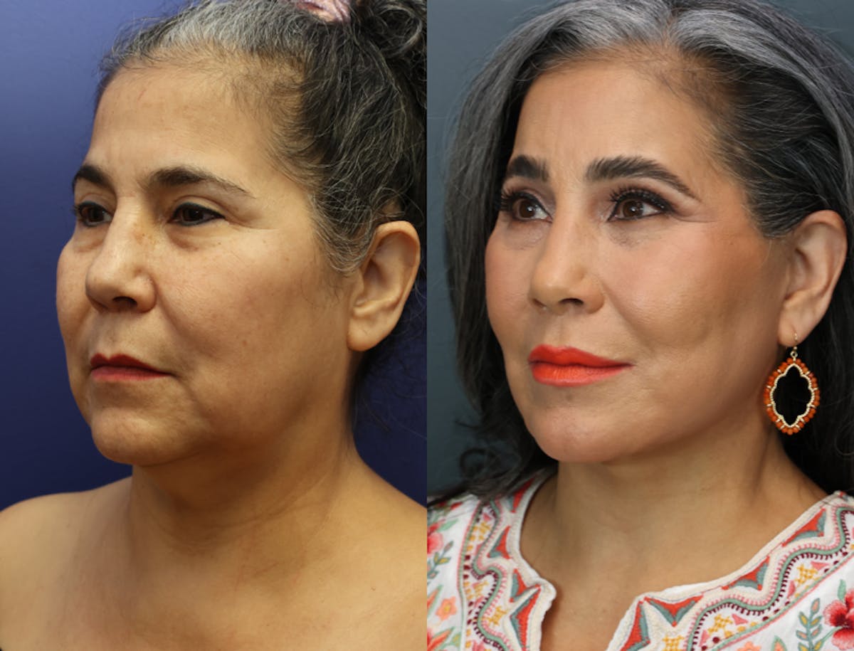 Deep Plane Neck Lift Before & After Gallery - Patient 258794 - Image 5
