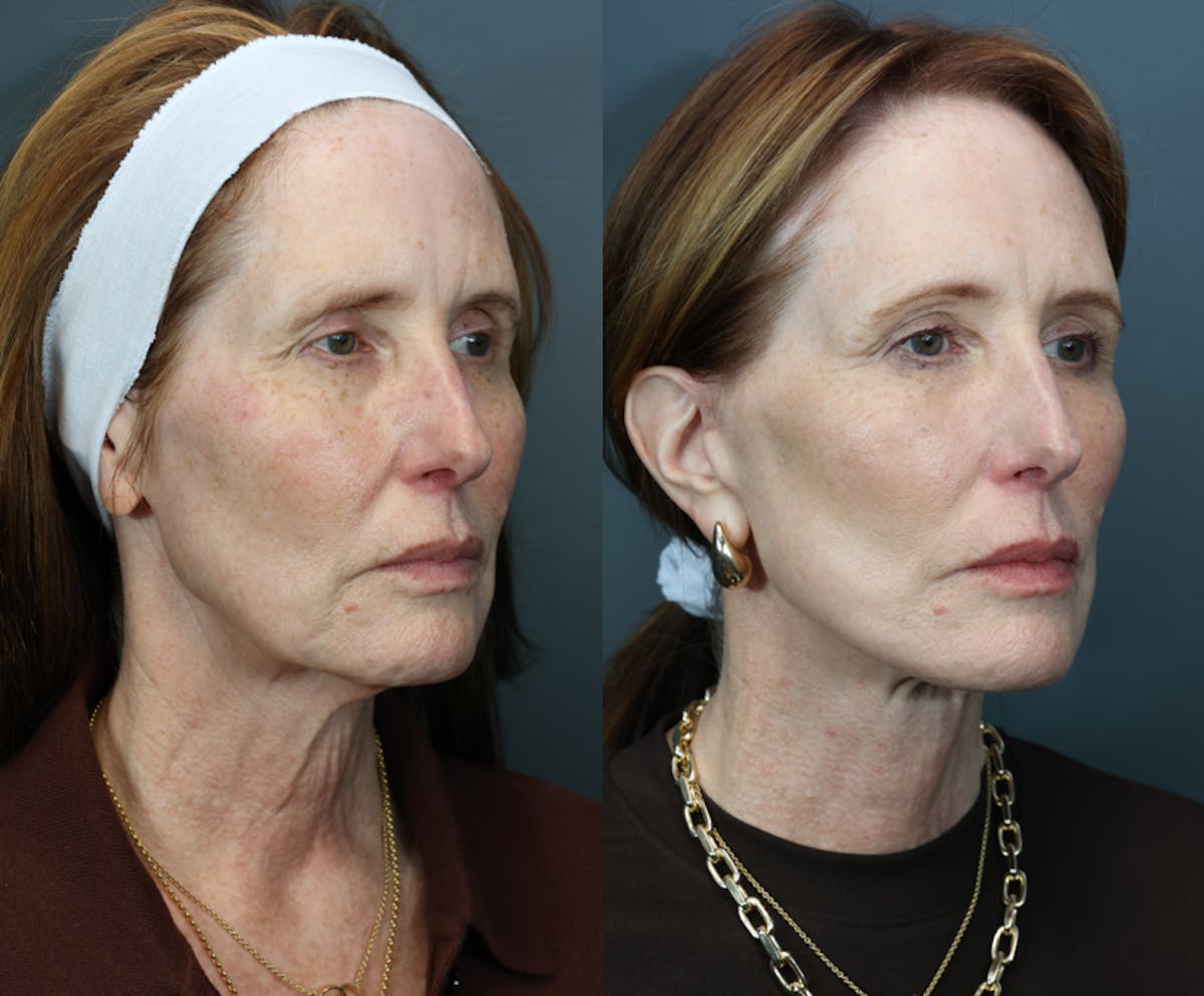 Deep Plane Neck Lift Before & After Gallery - Patient 281047 - Image 3