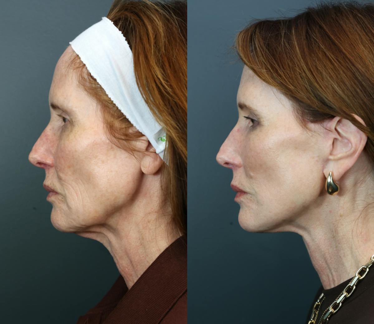 Deep Plane Neck Lift Before & After Gallery - Patient 281047 - Image 4