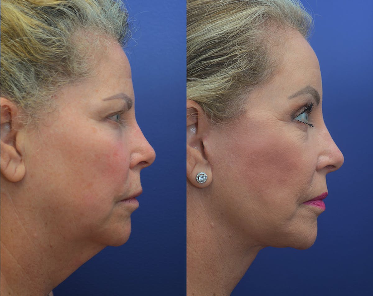 Deep Plane Neck Lift Before & After Gallery - Patient 927046 - Image 1