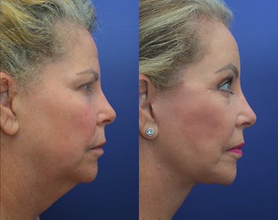 Full Facial Rejuvenation Before & After Gallery - Patient 712249 - Image 1