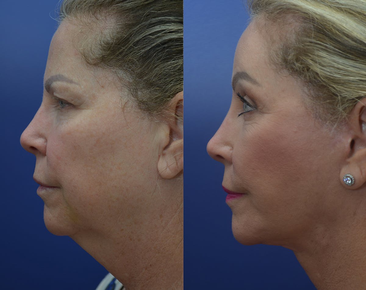 Deep Plane Neck Lift Before & After Gallery - Patient 927046 - Image 2