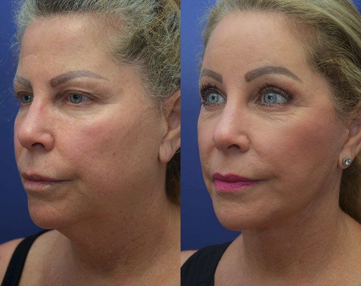 Deep Plane Neck Lift Before & After Gallery - Patient 927046 - Image 3