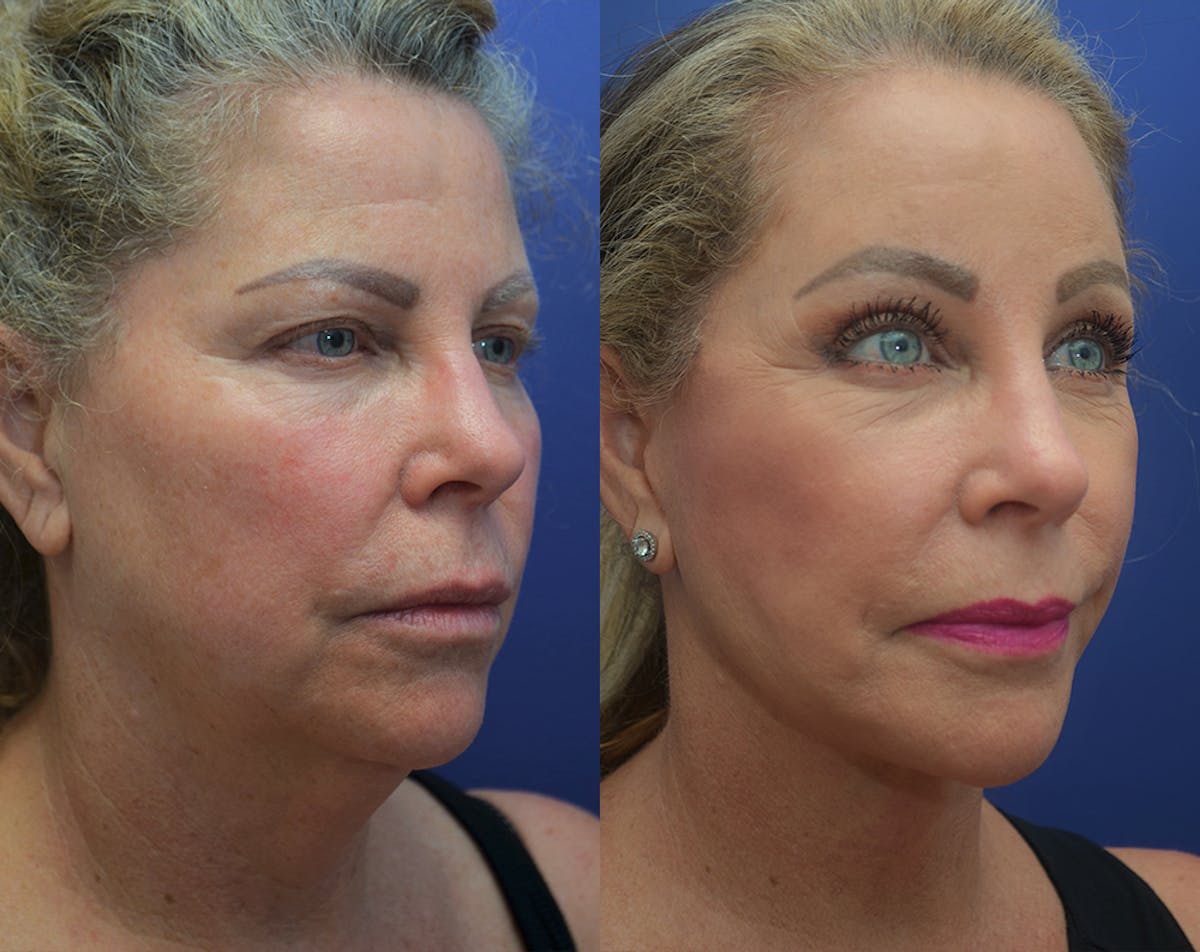 Deep Plane Neck Lift Before & After Gallery - Patient 927046 - Image 4