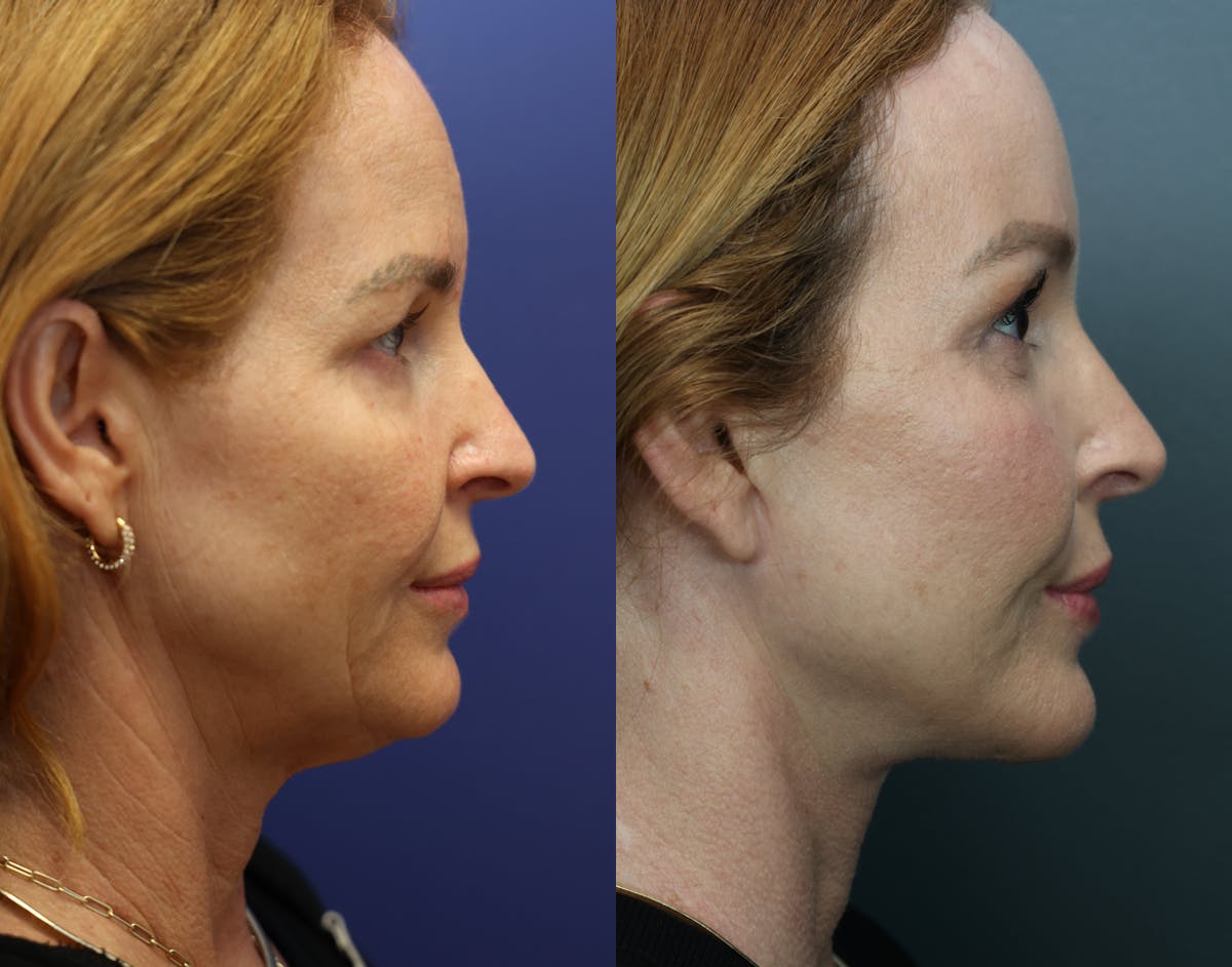 Eyelid Surgery Before & After Gallery - Patient 220048 - Image 4