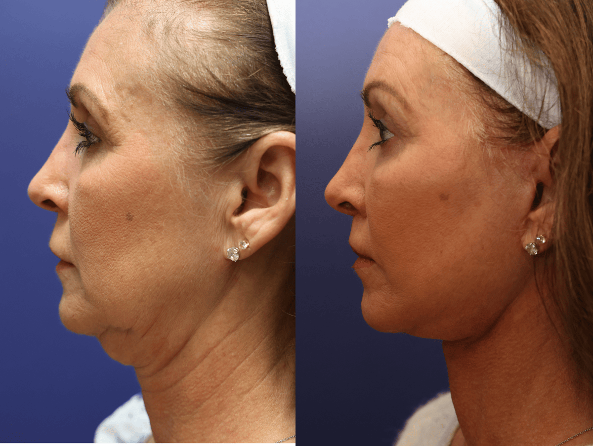 Facial Revolumizing (Fat Grafting) Before & After Gallery - Patient 284768 - Image 5