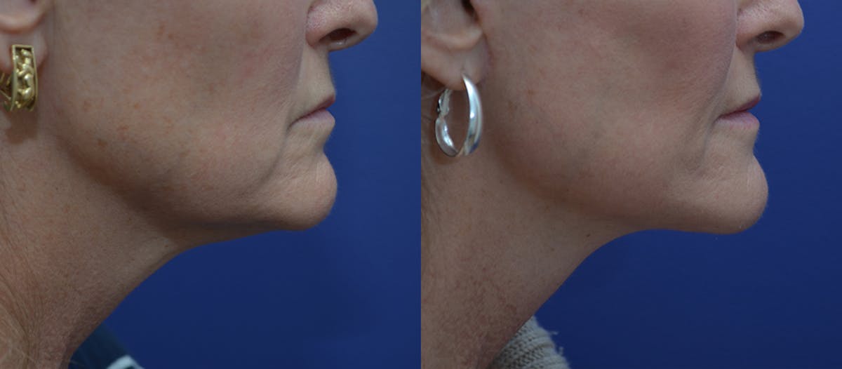Deep Plane Neck Lift Before & After Gallery - Patient 311758 - Image 1