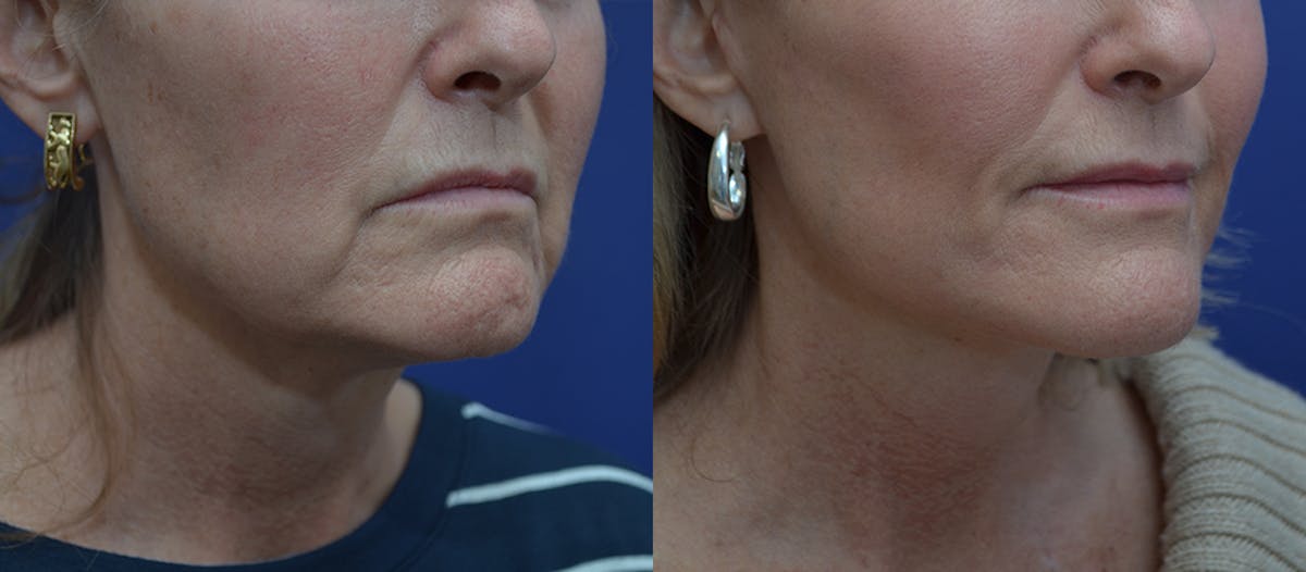 Deep Plane Neck Lift Before & After Gallery - Patient 311758 - Image 2