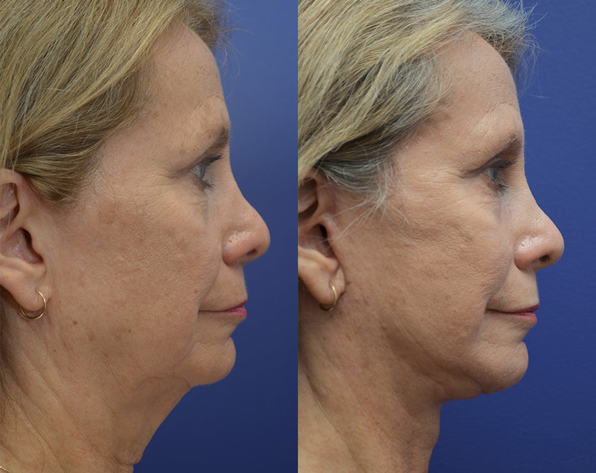Deep Plane Neck Lift Before & After Gallery - Patient 191832 - Image 1