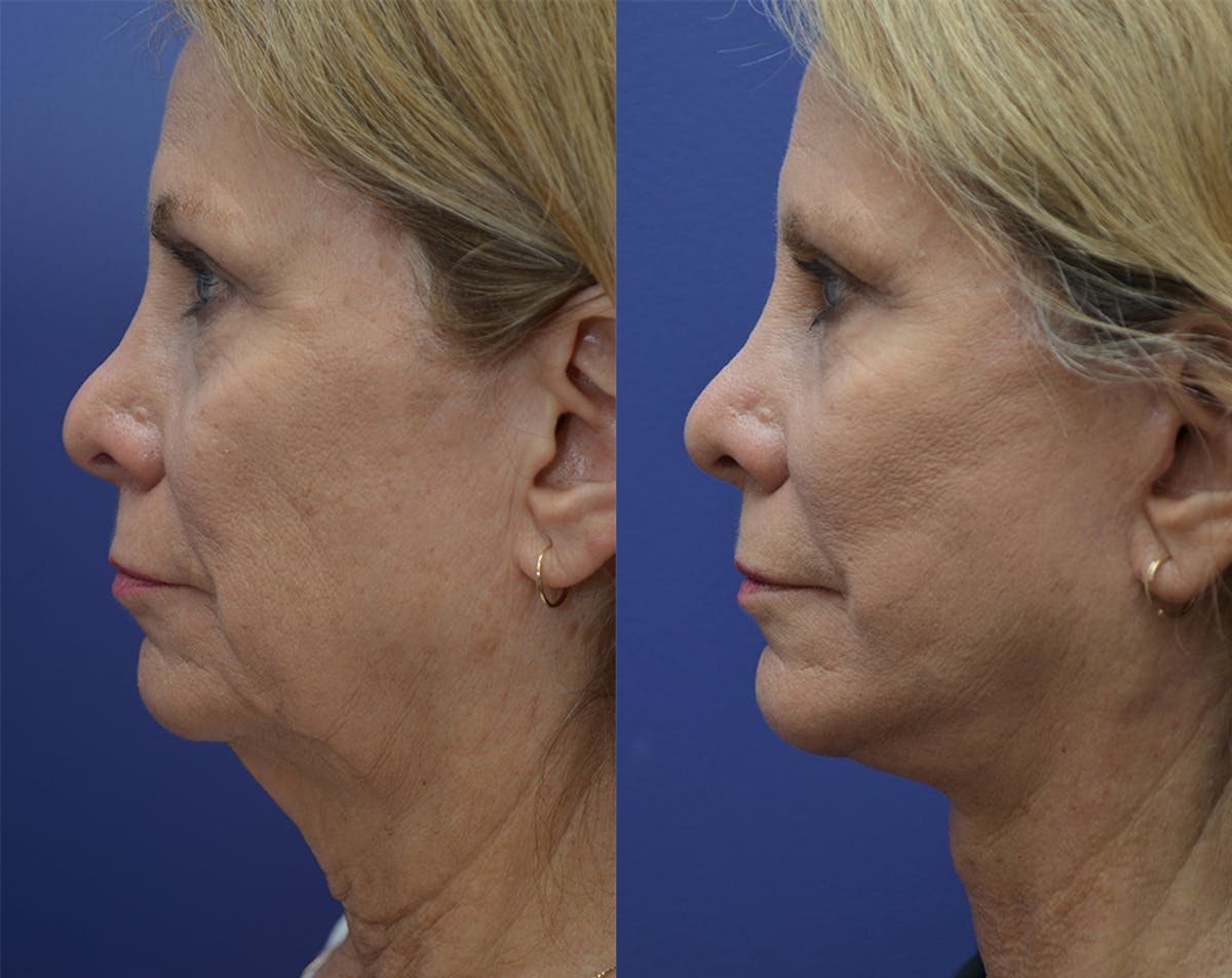 Deep Plane Neck Lift Before & After Gallery - Patient 191832 - Image 2