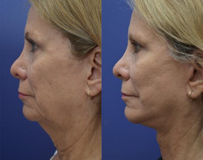 Full Facial Rejuvenation Before & After Gallery - Patient 295987 - Image 2