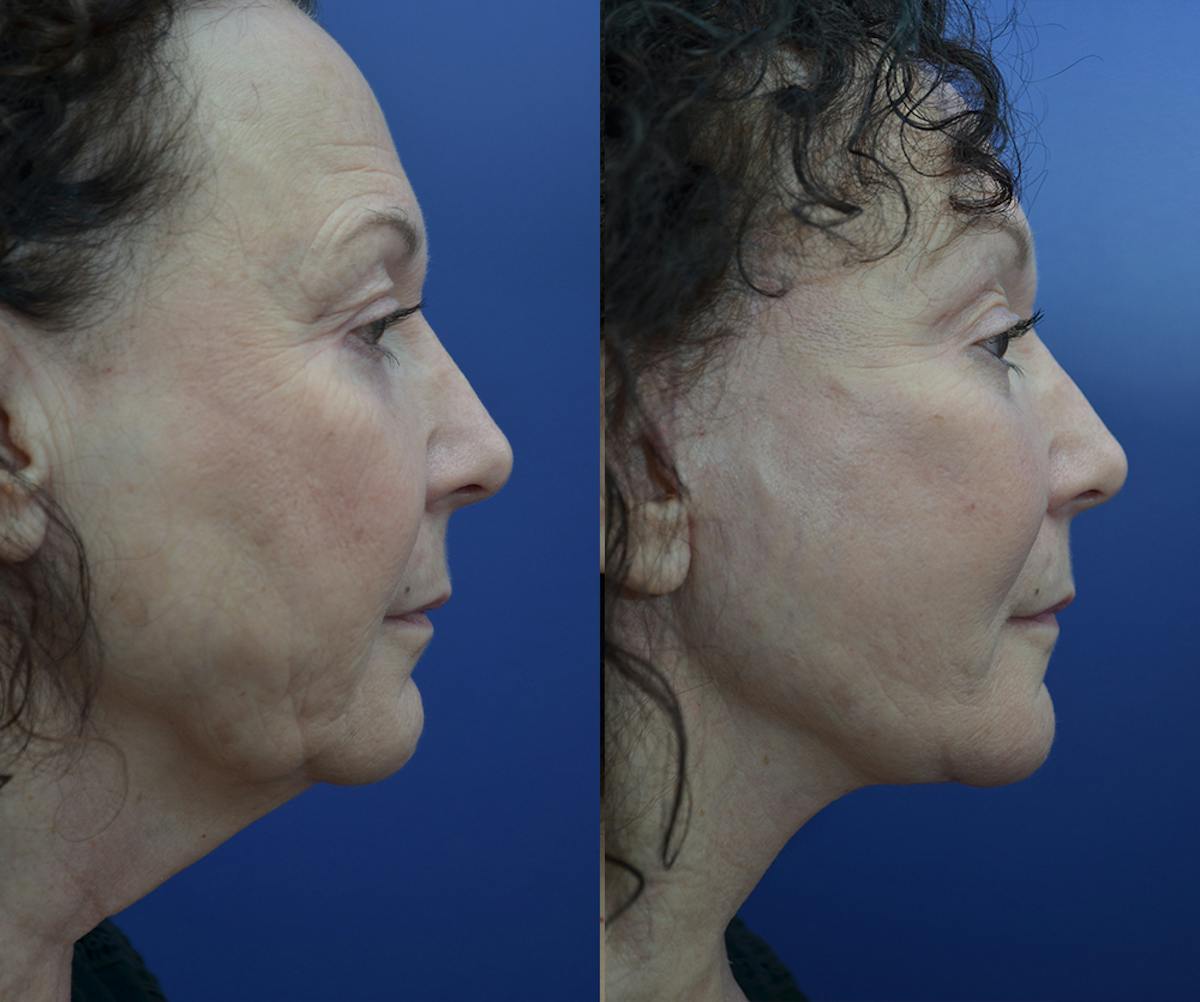 Deep Plane Neck Lift Before & After Gallery - Patient 129432 - Image 1