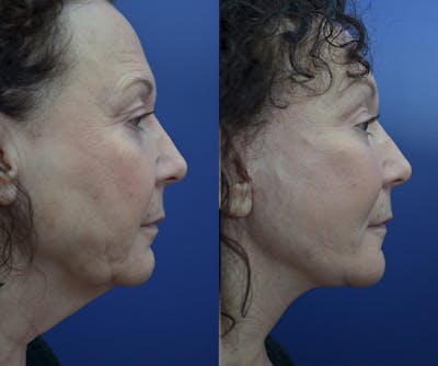 Full Facial Rejuvenation Before & After Gallery - Patient 197738 - Image 1