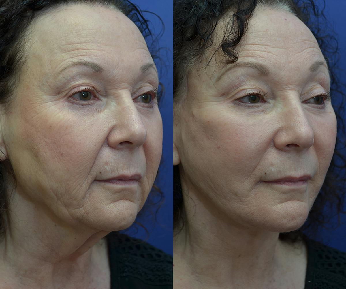 Deep Plane Neck Lift Before & After Gallery - Patient 129432 - Image 2