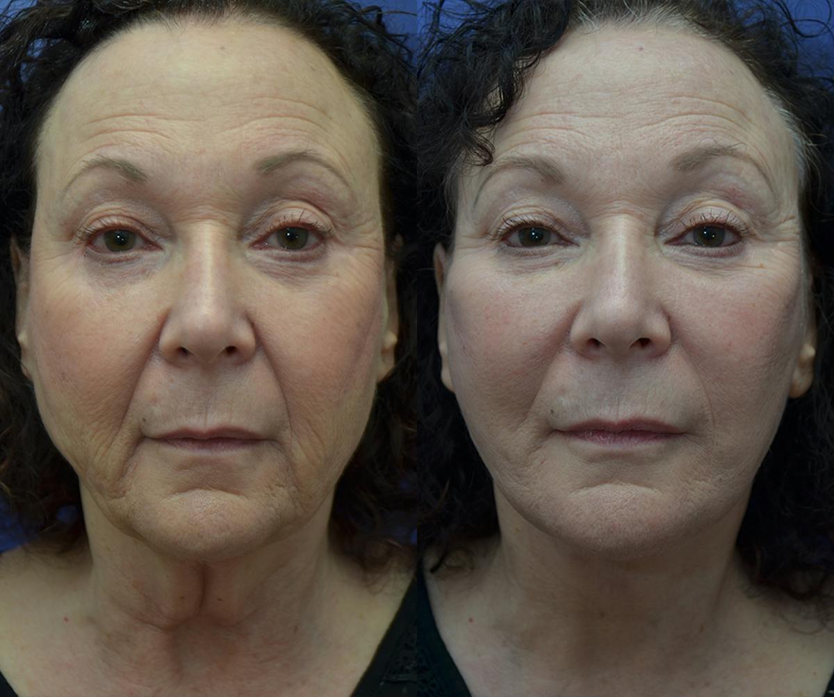 Deep Plane Neck Lift Before & After Gallery - Patient 129432 - Image 3