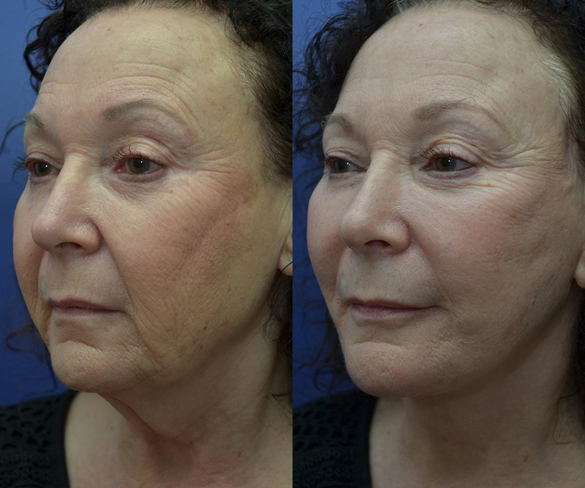 Deep Plane Neck Lift Before & After Gallery - Patient 129432 - Image 4