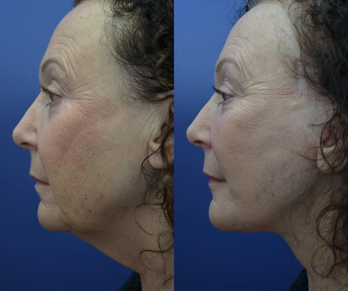 Deep Plane Neck Lift Before & After Gallery - Patient 129432 - Image 5
