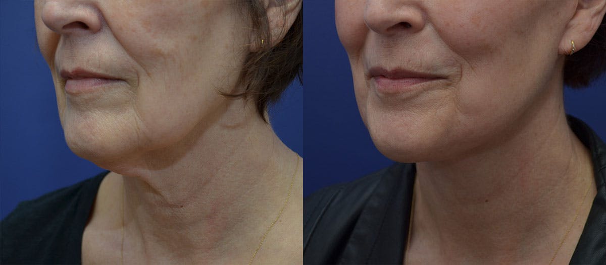 Deep Plane Neck Lift Before & After Gallery - Patient 109573 - Image 1