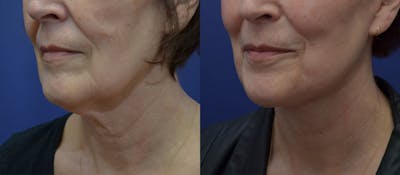 Full Facial Rejuvenation Before & After Gallery - Patient 419934 - Image 1