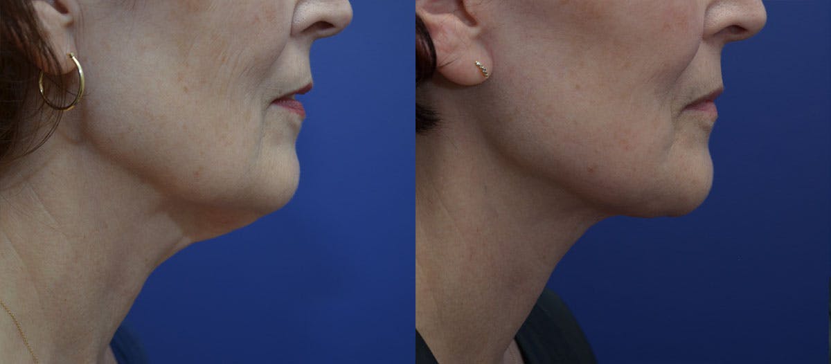 Deep Plane Neck Lift Before & After Gallery - Patient 109573 - Image 3