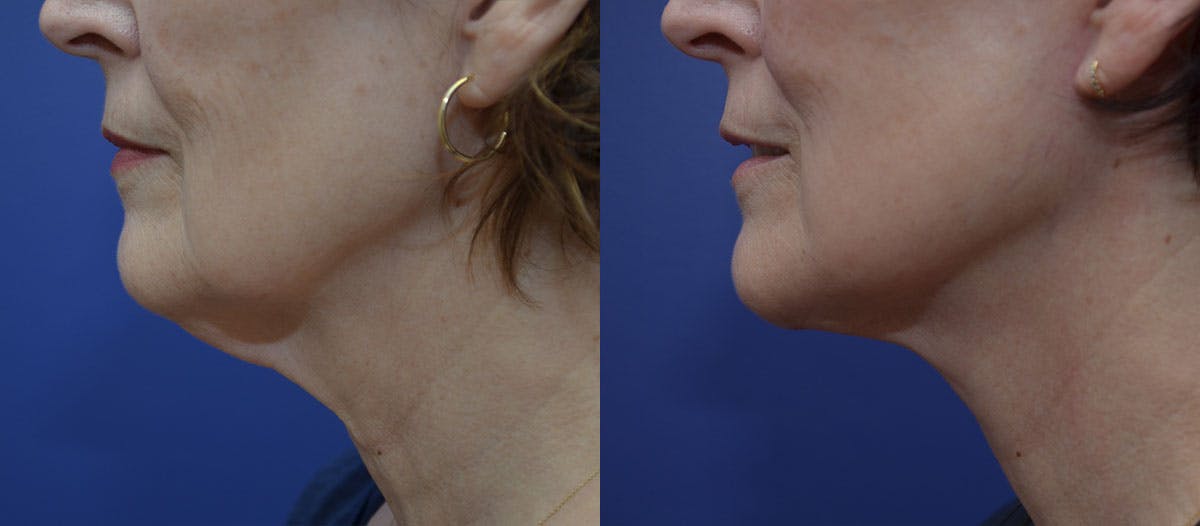 Deep Plane Neck Lift Before & After Gallery - Patient 109573 - Image 4
