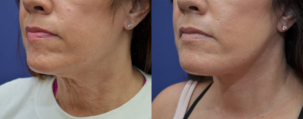 Deep Plane Neck Lift Before & After Gallery - Patient 250444 - Image 1