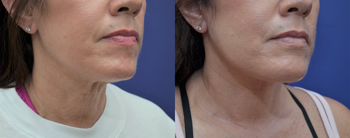 Deep Plane Neck Lift Before & After Gallery - Patient 250444 - Image 2