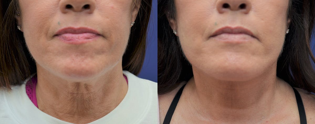 Deep Plane Neck Lift Before & After Gallery - Patient 250444 - Image 3