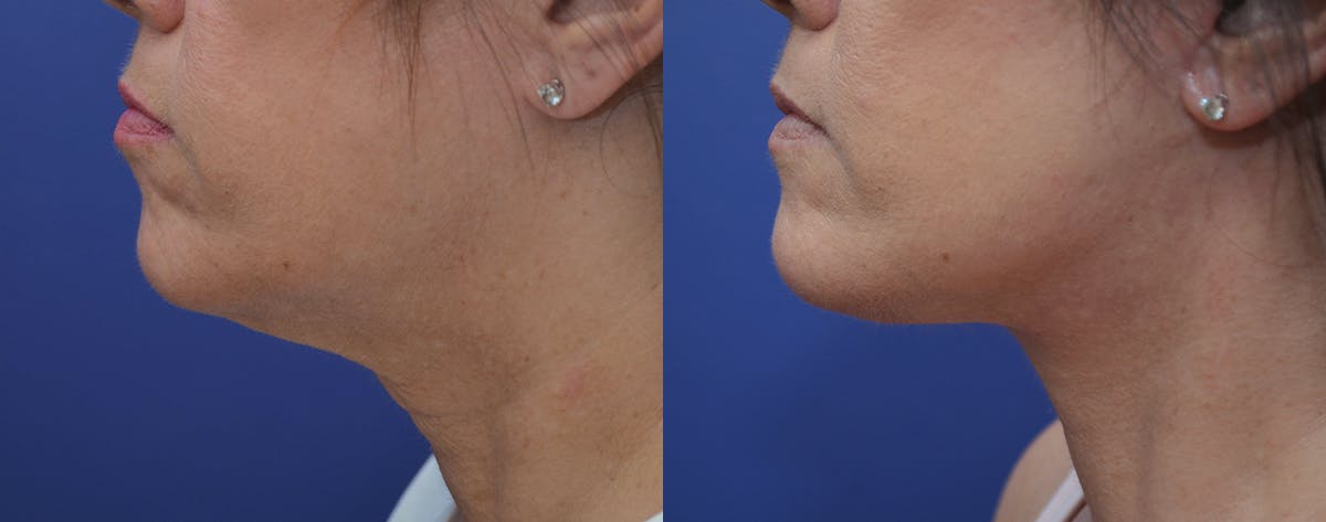 Deep Plane Neck Lift Before & After Gallery - Patient 250444 - Image 4