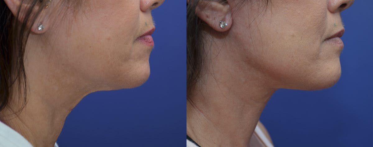 Deep Plane Neck Lift Before & After Gallery - Patient 250444 - Image 5