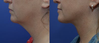 Full Facial Rejuvenation Before & After Gallery - Patient 396180 - Image 1