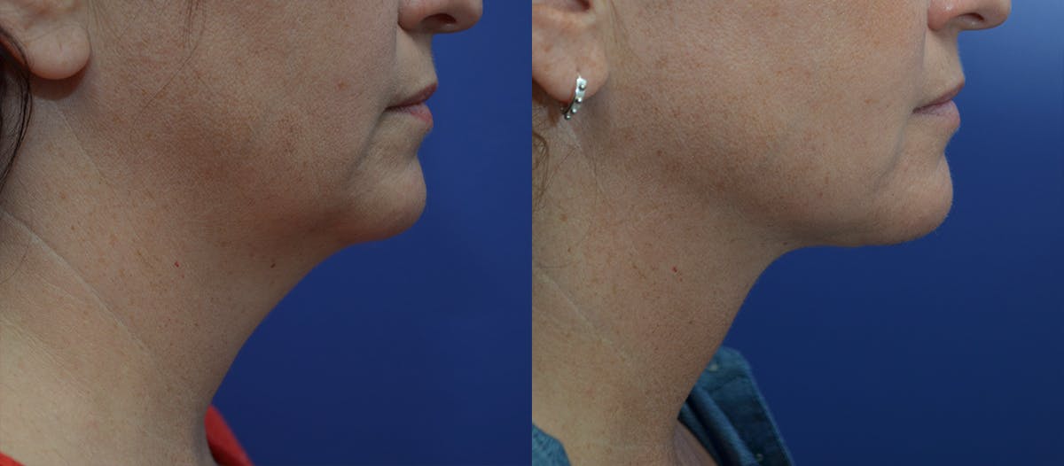 Full Facial Rejuvenation Before & After Gallery - Patient 396180 - Image 2