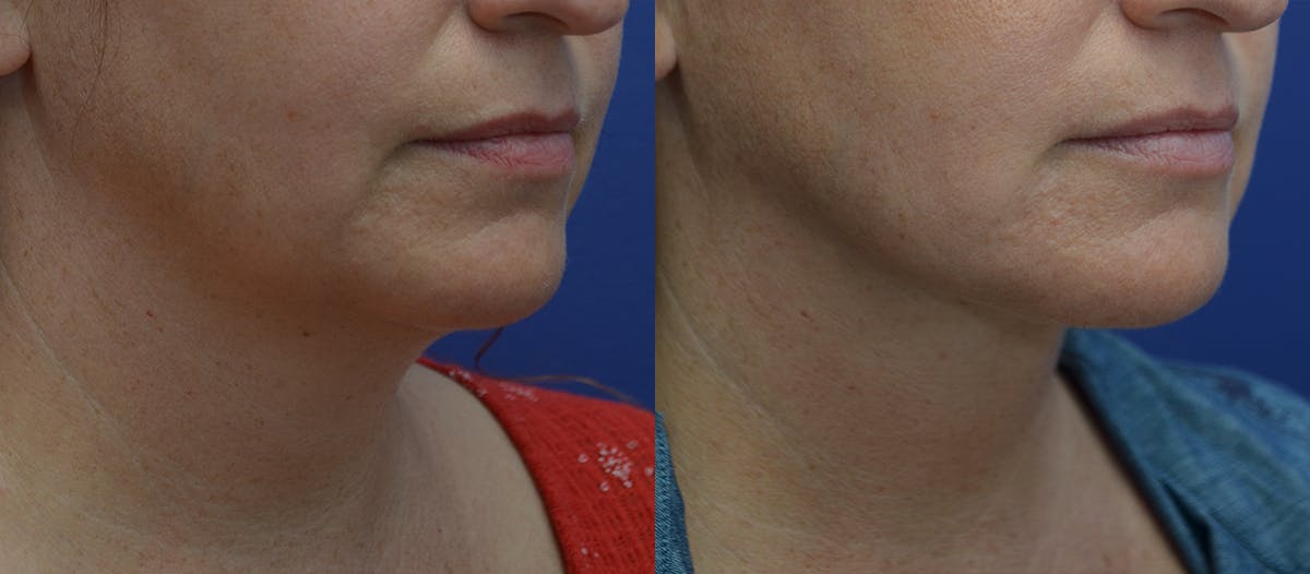 Full Facial Rejuvenation Before & After Gallery - Patient 396180 - Image 3