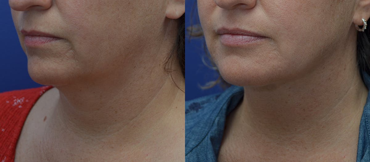 Full Facial Rejuvenation Before & After Gallery - Patient 396180 - Image 4