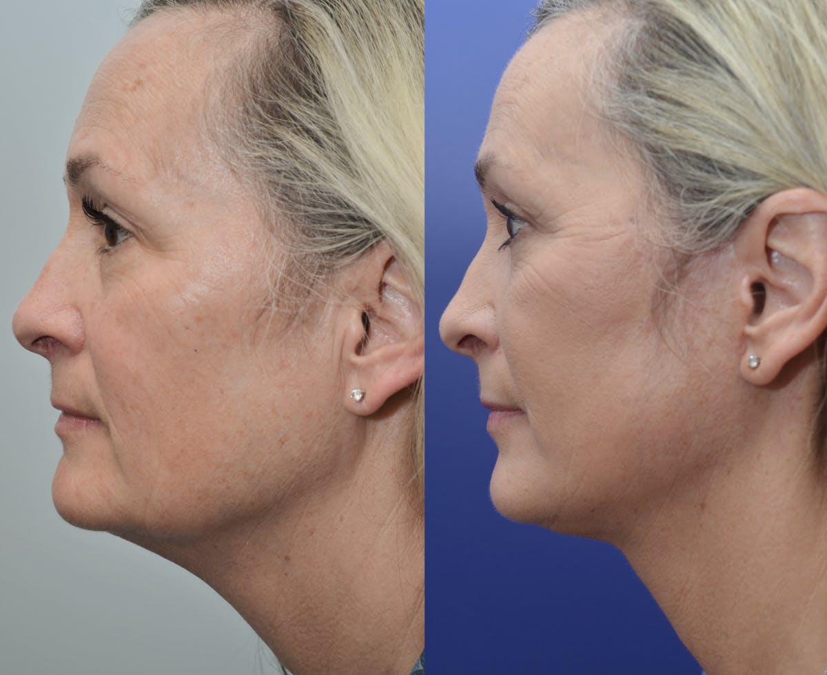 Deep Plane Neck Lift Before & After Gallery - Patient 131337 - Image 1