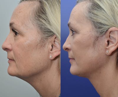 Full Facial Rejuvenation Before & After Gallery - Patient 207504 - Image 1