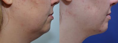 Full Facial Rejuvenation Before & After Gallery - Patient 379469 - Image 1