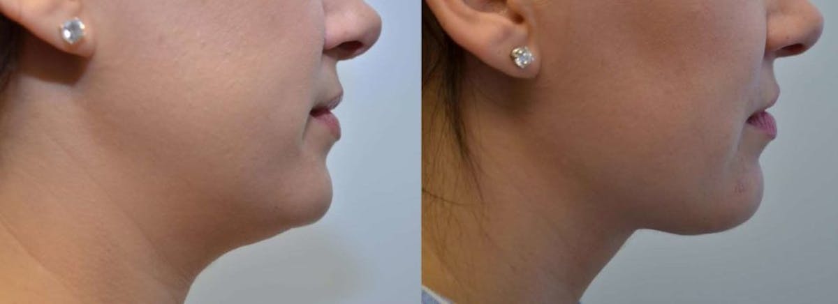 Full Facial Rejuvenation Before & After Gallery - Patient 146136 - Image 1