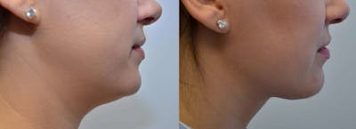 Full Facial Rejuvenation Before & After Gallery - Patient 146136 - Image 1