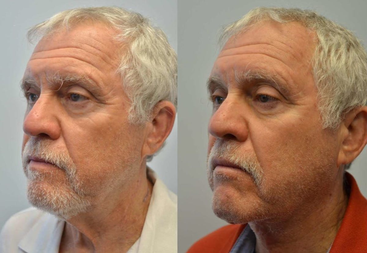 Deep Plane Neck Lift Before & After Gallery - Patient 329959 - Image 1