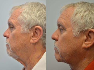 Full Facial Rejuvenation Before & After Gallery - Patient 104188 - Image 2