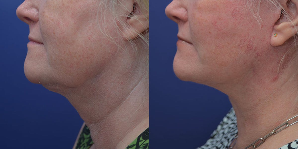 Deep Plane Neck Lift Before & After Gallery - Patient 205411 - Image 1