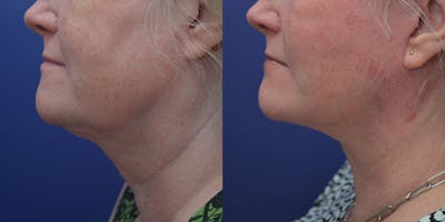 Full Facial Rejuvenation Before & After Gallery - Patient 242852 - Image 1