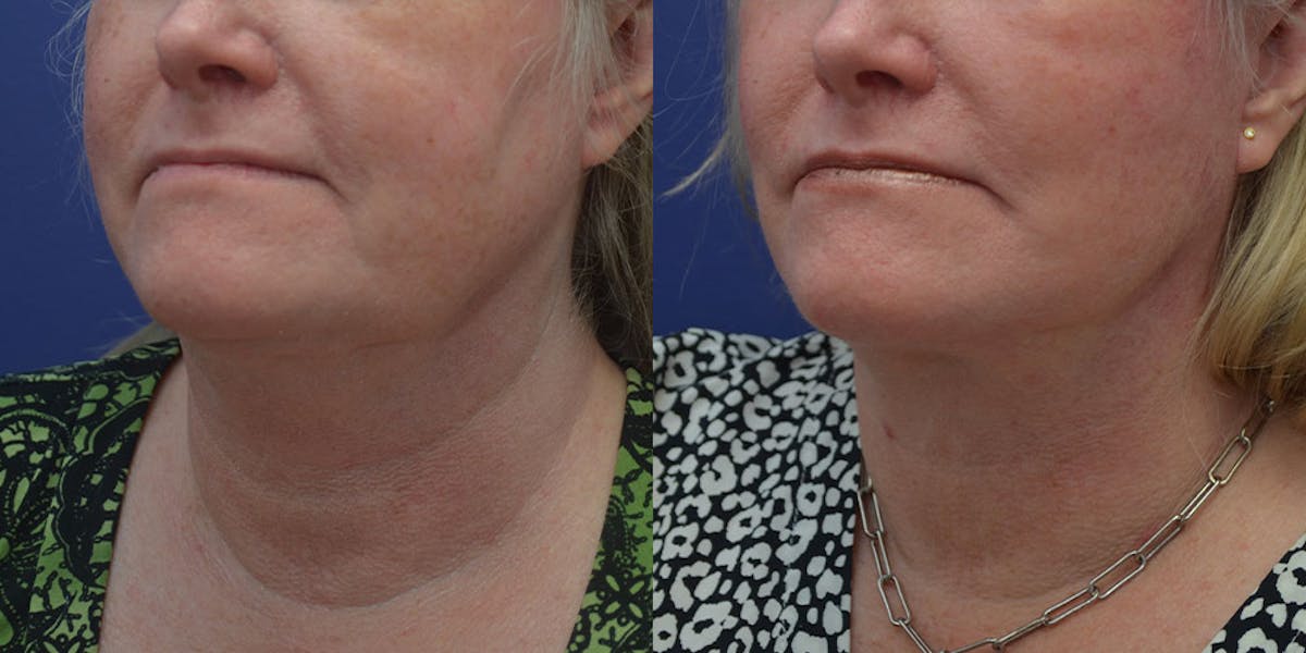 Deep Plane Neck Lift Before & After Gallery - Patient 205411 - Image 2