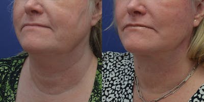 Full Facial Rejuvenation Before & After Gallery - Patient 242852 - Image 2