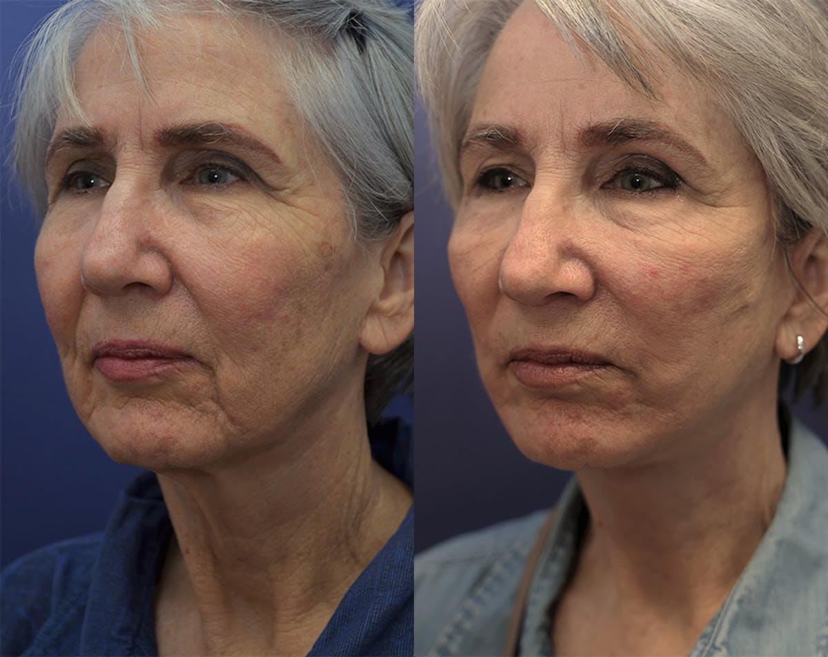 Deep Plane Neck Lift Before & After Gallery - Patient 246592 - Image 1