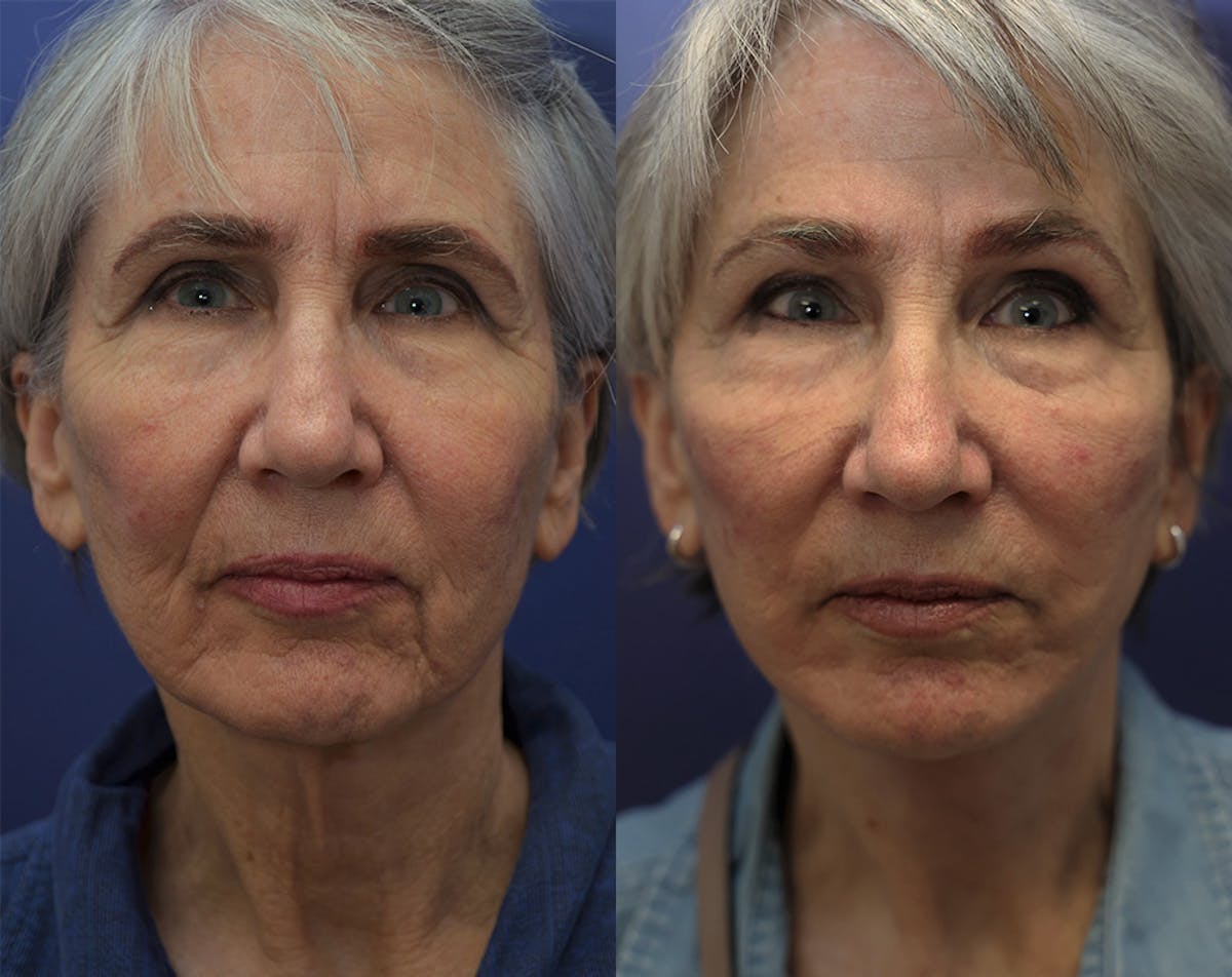 Deep Plane Neck Lift Before & After Gallery - Patient 246592 - Image 2