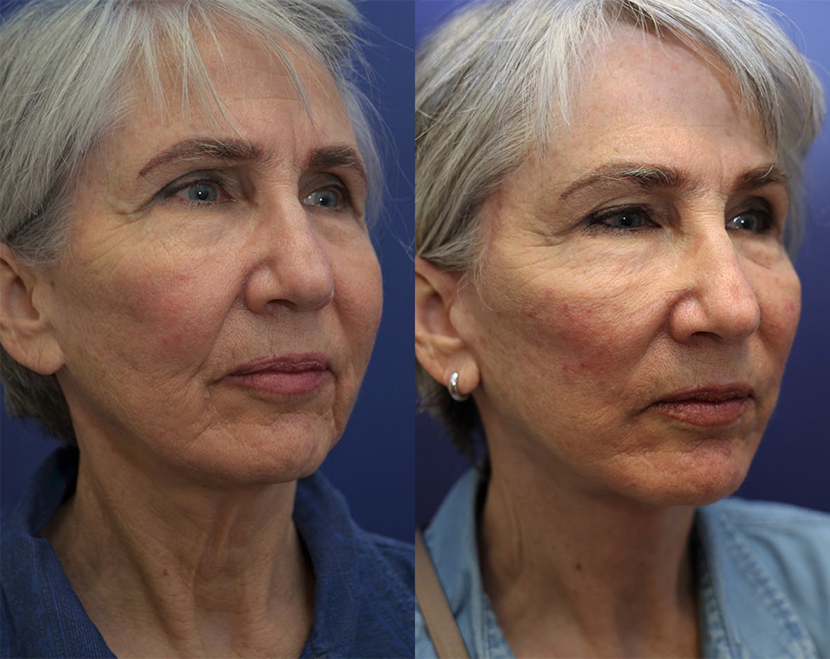 Deep Plane Neck Lift Before & After Gallery - Patient 246592 - Image 4