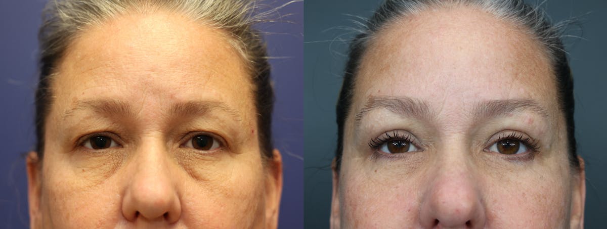Eyelid Surgery Before & After Gallery - Patient 161319 - Image 1