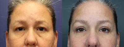 Blepharoplasty Before & After Gallery - Patient 100685 - Image 1